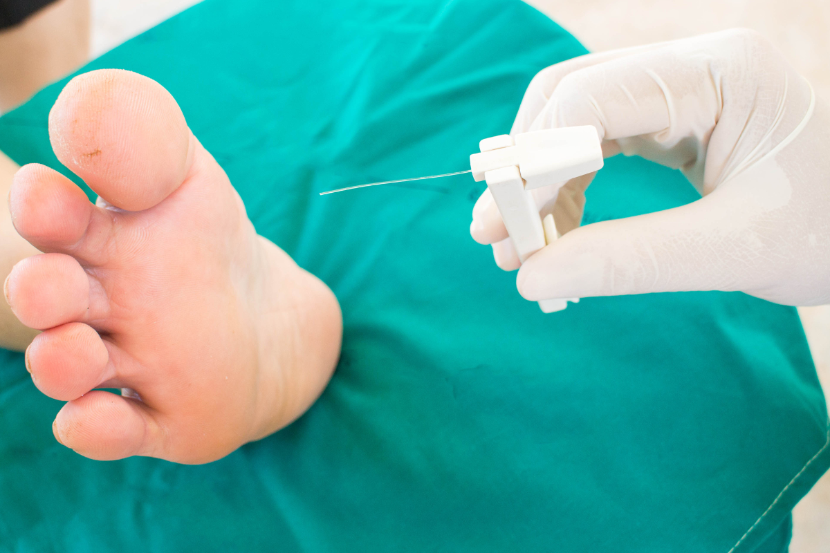 Biothesiometer vs. Monofilament Which is Better for Diabetic